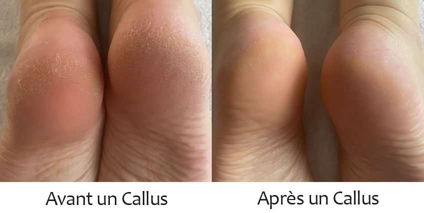 SOIN CALLUS